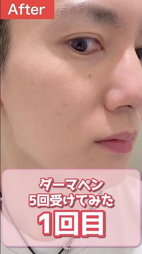 [First attempt] How much can my skin improve after thoroughly damaging it with a 5-session Dermap...