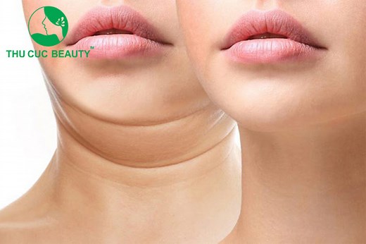 Hút mỡ nọng cằm và các lưu ý cần biết - Bệnh viện Thẩm mỹ Thu Cúc