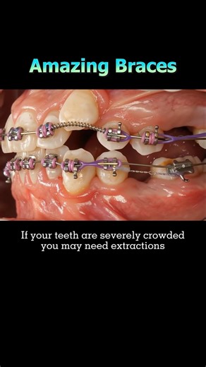 Amazing Braces: The process of tooth movement during orthodontic treatment. #braces #asmr #dentist