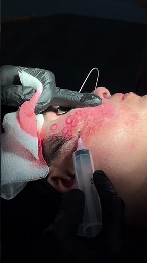 Phase I Acne Scar Treatment