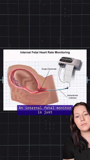 Internal fetal monitoring is a form of continuous monitoring during birth. Benefits: -(When compared with continuous external monitoring) May detect the heart rate more accurately if the continuous fetal monitor has trouble due to the baby moving, or if the monitors are slipping. -The IUPC (catheter in the uterus) can identify the strength of contractions (though that is rarely necessary information). Risks: -Increases the risk for infection -Requires AROM which comes with it’s own risks -Requir