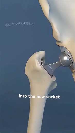 Hip Replacement surgery (3D Animation)#hipreplacements #hipreplacment #hipreplacementsuccess
