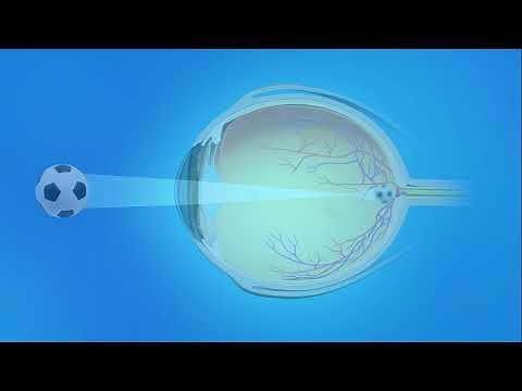 Miopía (visión de cerca)