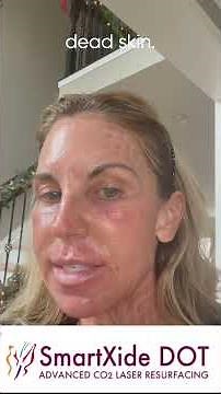 SmartXIDE DOT CO2 Laser Skin Resurfacing Day 4 Actual Patient Live Video Journal RealSelfie Vide...