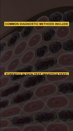 Diagnosis of Tuberculosis