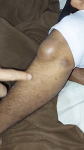 হাটুর ফোলা Infrapatellar Bursitis | Dr. Khaled Hasan Milu