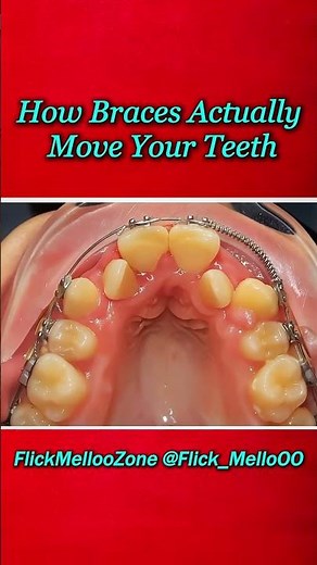 Braces Transformation Timelapse 😮 Straight Teeth Journey