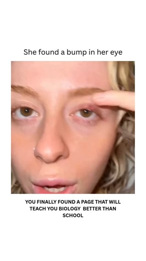 BIOLOGY | HEALTH | MEDICAL | An eye sty (hordeolum) is a painful, red lump on the eyelid caused by a bacterial infection, typically Staphylococcus aureus. It can occur... | Instagram