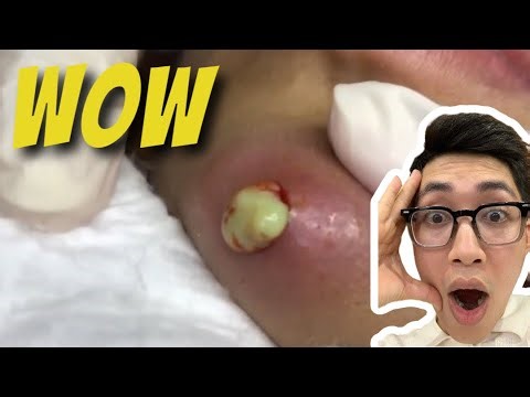 I POPPED 10 high Pressure Abscess in 1 Day and here's What Happened (Part6)