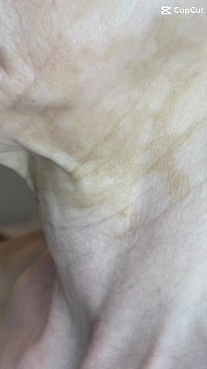 My lovely client had a full face lift and neck treatment. Restoration of my client's lower neck and face, as well as the immediate aftereffects, as well as some process tips and pointers. Fibroblast during the process the plasma comes into contact with the skin’s surface, applying a direct heat. This is transferred into the inner papillary layers of the skin, this is what is known as fibroblast cells. These cells are responsible for generating connective tissue, and allowing the skin to recover 