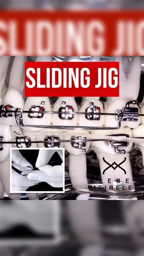 Orthodontic Mentor Pro | The use of elastics for Class II correction is extremely common in orthodontics, but everything depends on the magnitude of the problem... | Instagram