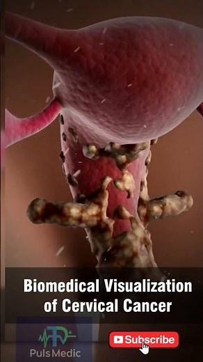 Cervical Cancer 3D Animation