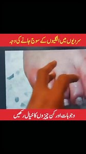 Chilblains cause painful, itchy finger swelling. Cold weather narrows blood vessels; rapid rewarming then leaks fluid, creating red, inflamed, puffy skin. | Dr Shahbaz Akhtar