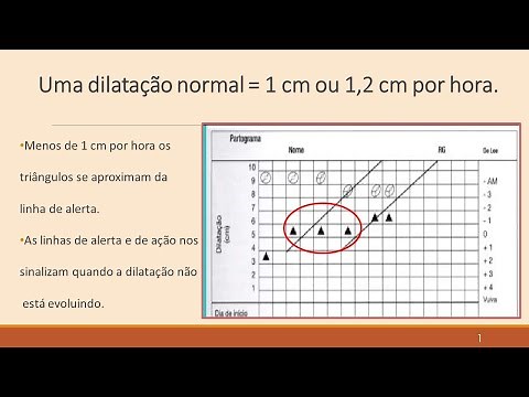 Partograms and dystocia#. Let's identify 2 dystocias. #partogramsanddystocias.