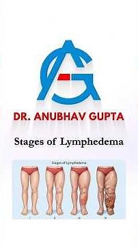 Stages of Lymphedema Explained | Stage 0 to Stage 3 Symptoms & Progression Guide