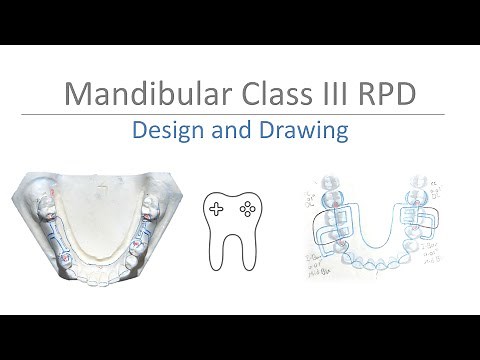 Mandibular Class III RPD Design: Step-by-Step Guide to Surveying & Drawing on Casts and Paper