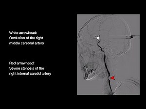Digital Subtraction Angiography During Surgery