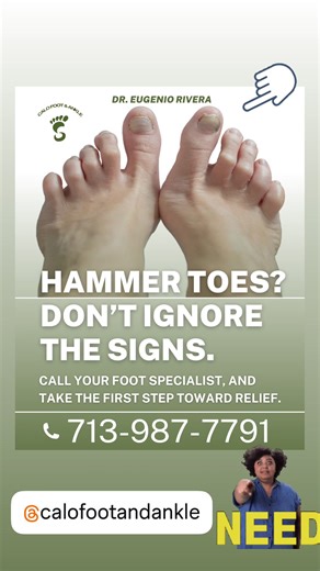 Hammer Toes? Don’t ignore the signs. They’re often caused by muscle and tendon imbalances most commonly from wearing shoes that are too tight, pointed, or high-heeled. @calofootandankle Other factors like injuries, arthritis, diabetes, bunions, and even genetics can also play a role. Don’t wait until it becomes painful or affects your walk. Call your foot specialist, Dr. Eugenio Rivera at Calo Foot & Ankle, and take the first step toward relief. Call: 713-987-7791 6565 West Loop S Suite 675 Bell