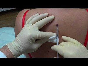 Removal of seborrheic keratoma (keratoma senile)