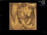 Ultrasound Image of Pregnancy • Video • MEDtube.net