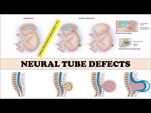 #Neuraltubedefects#spinabifida#meningomyelocele#meningocele#Anencephaly#Encephalocele