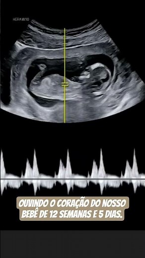 Ultrassom de 12 semanas e 5 dias: Ouvindo o coração do bebê ❤️