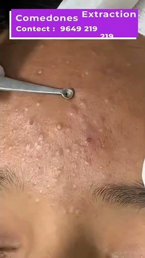 Here's A Quick Way To Solve The Comedones Extraction Problem | Viral #shorts