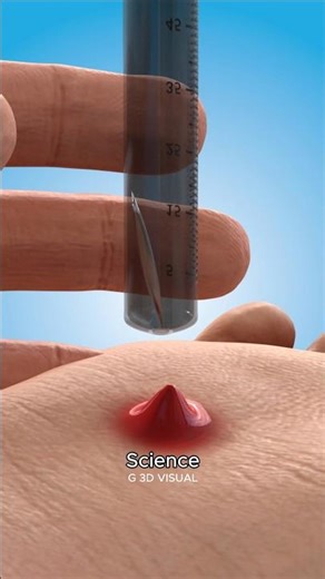 You Won’t Believe How This Suction Trick Removes Splinters! 🤯