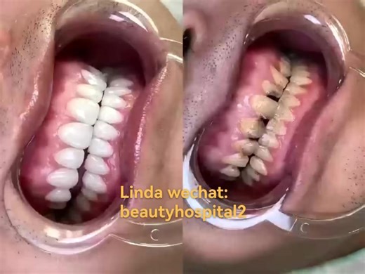 Veneer. beauty teeth whitening teeth #veneer #whiteningteeth #beautyteeth
