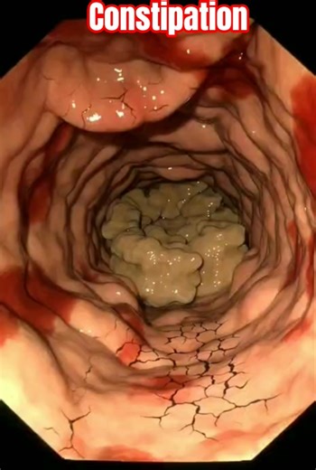 Realistic Human Anatomy Visualization Severe constipation | 3D Organs| #science #shorts