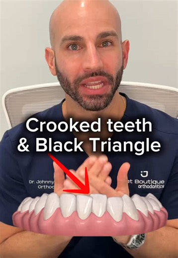 Transform Your Smile with Invisalign: Adult Case Study