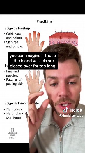 Understanding Frostbite: Causes, Symptoms, and Recovery