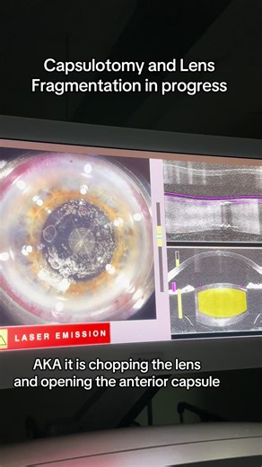 LenSx Laser Cataract Surgery Explained