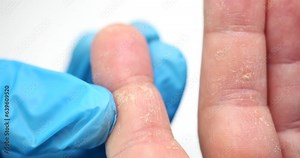 Dry hands peeling of skin on hands and fingers. Chemical allergy dermatitis and eczema