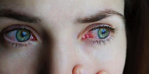 Conjuntivitis podría ser primer síntoma de coronavirus
