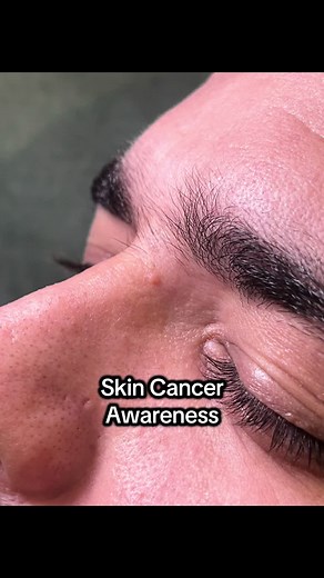 Basal Cell Carcinoma Awareness: Understanding Skin Cancer
