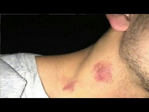 HOW TO GIVE A HICKEY QUICK AND EASY