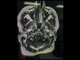 Left Middle Fossa Approach for a Recurrent Cavernous Meningeoma • Video • MEDtube.net