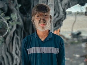 Dünyanın en tuhaf hastalıklarından birine sahip: Yaşayan 'Kurt Adam'