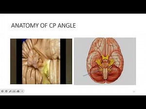 Retrosigmoid Approach to the Cerebellopontine Angle