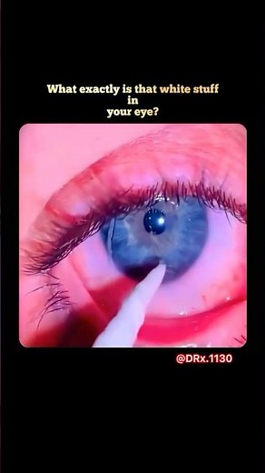 Why do your eyes have sticky white discharge when you wake up?