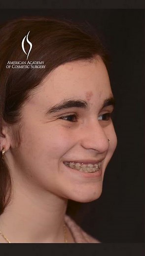 Jaw Surgery Simulation: Cutting-Edge Technology at Work #AACS #jawlinegoals #jawline #jawsurgery