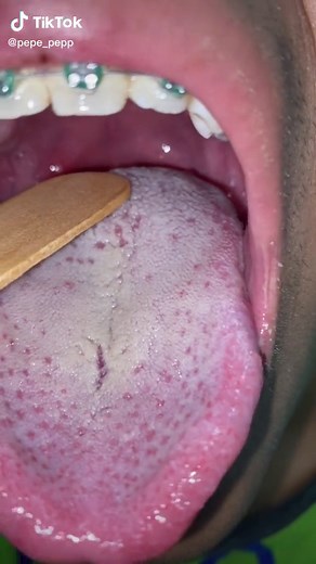 INFECCIÓN DE AMÍGDALAS #doctor #medicine #medicina #salud #sickness #amigdalas #fyp #fypシ #parati #doctorexplains #viraltiktok #video #viral #infecction #infeccion #garganta #cuidados #amigdalas