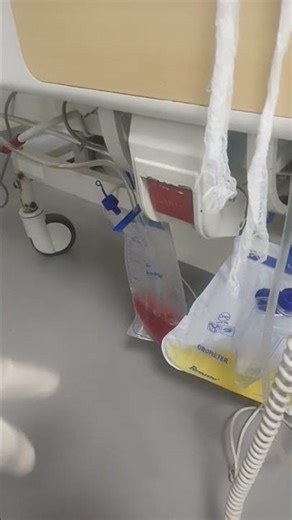 managing a case of subcutaneous emphysema #emphysema #intercostaldrain