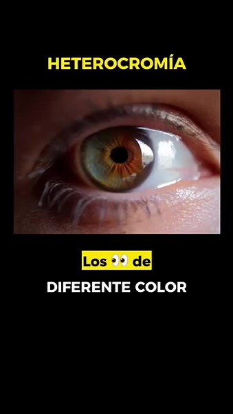 Entendiendo la heterocromía del iris y sus causas