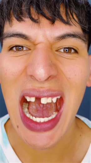 Prótesis dentales MrDent Entrega en 3 horas #mrdent #smile #dentistry #veneers | Mister Dent