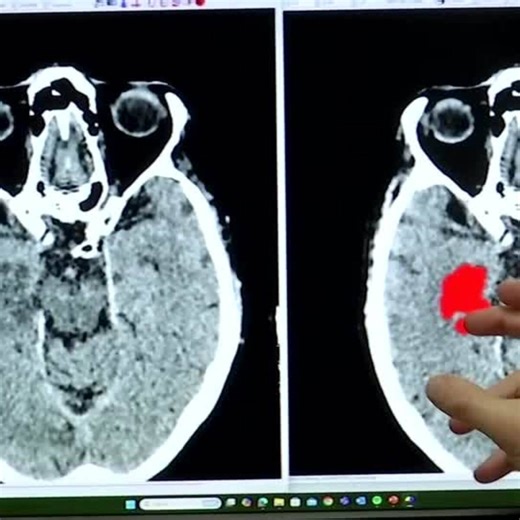 New AI software doubles stroke diagnosis accuracy