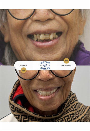 Max came in after years of dealing with periodontal disease, infection, and decaying teeth. The goal wasn’t just to treat his teeth — it was to support his overall health. 5 days after treatment, he shared that he felt good and was grateful for the care he received. Hearing a patient say they’d recommend us to anyone is a reminder of why this work matters. ✨ If this story resonates with you, we’re here to talk whenever you’re ready. Check out the link in our bio to learn more 🦷🔗 . . . . . #den