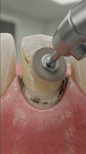 3D Dental Crown Upgrade Old Black Crown → Ultra Realistic Zirconia Replacement