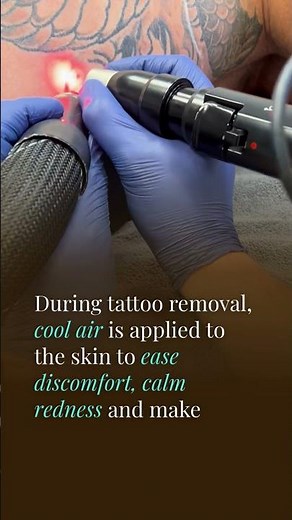 Precise Laser Tattoo Removal with PicoSure Pro | Safer, Smarter Treatment